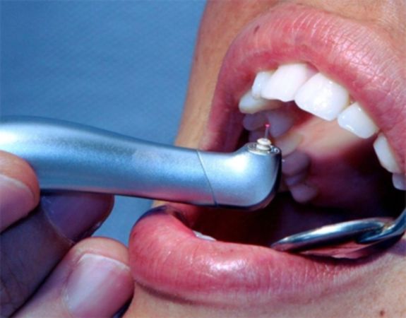 Les tarifs des soins dentaires dans le viseur de 60 millions de consommateurs.