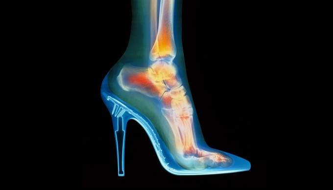 Nombreux accidents de talons en 10 ans