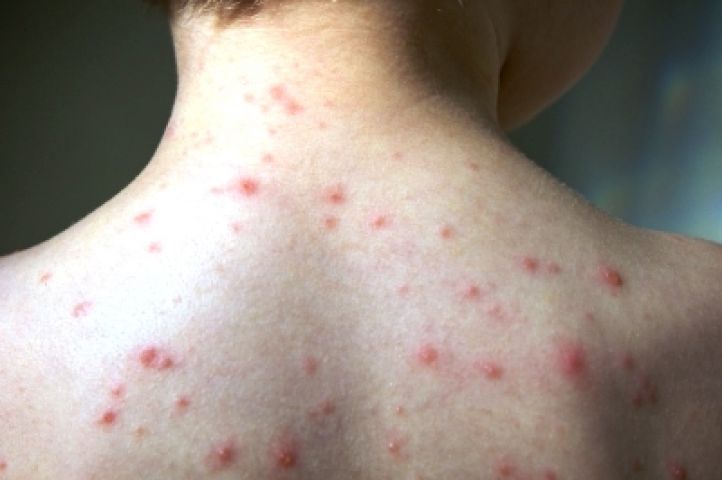 Région : prudence, la varicelle fait son grand retour !
